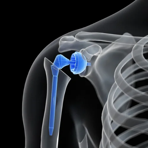 Arthroplasty 2