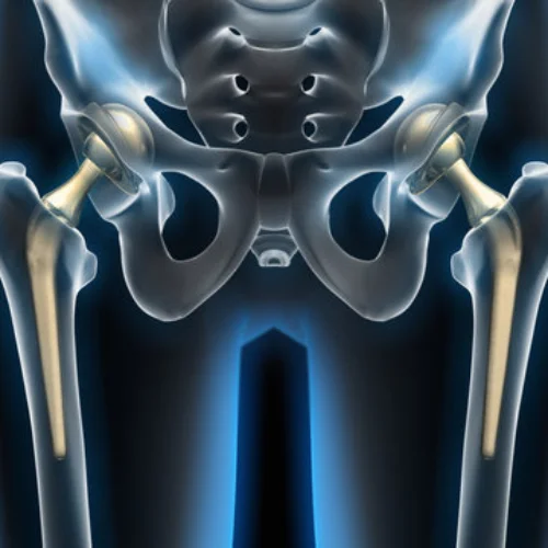 Joint Replacement 3