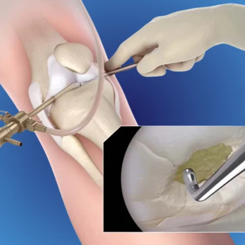 Arthroscopy Image 2
