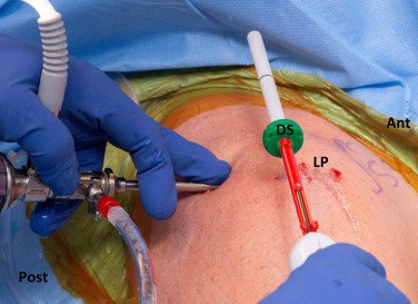InSpace Balloon Surgery for Rotator Cuff Tears