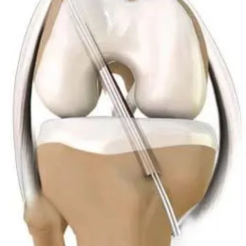 ACL Surgery