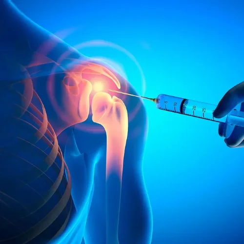 Joint Replacement 2