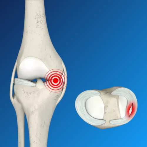 Knee Arthroscopy Procedure